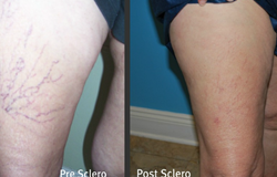 ftmyers-sclerotherapy-blog1