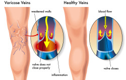 medical illustration of the effects of the varicose veins