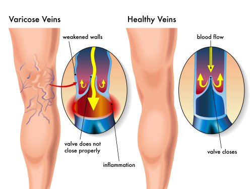 medical illustration of the effects of the varicose veins