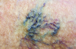 Varicose vein. Macro. Spider vein. Woman skin