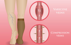 compression stocking therapy