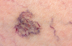 Varicose Veins