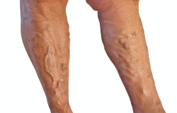 Varicose Veins