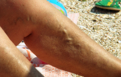 Varicose Veins