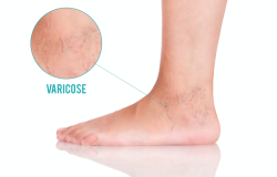 Varicose veins