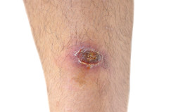 ulcer