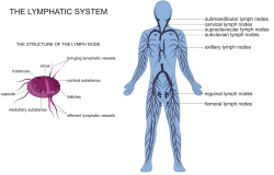 lymphedema