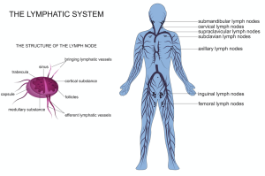 lymphedema