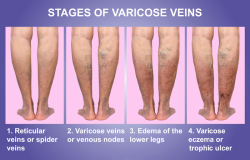 vein issues fort myers eveinscreening